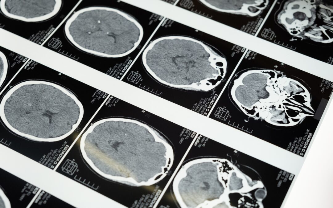 Personal Injury Damages in Brain Injury Cases
